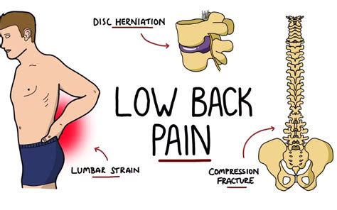 Image result for Left Lower Back Muscle Strain