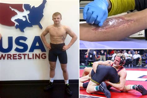 Flesh-eating bacteria sidelines college wrestler