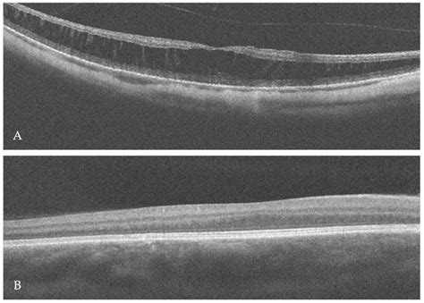 Aland Island Eye Disease with Retinoschisis in the Clinical Spectrum of ...