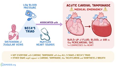 Beck?s Triad: What Is It, Associated Conditions, and More | Osmosis