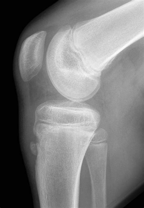 Osgood-Schlatter disease • LITFL • Medical Eponym Library