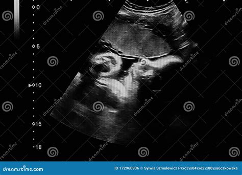 36 Weeks Sonography