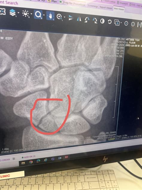 Scaphoid fracture : r/Bone