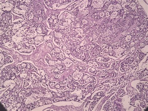 CLEAR CELL CARCINOMA OVARY – Histopathology.guru