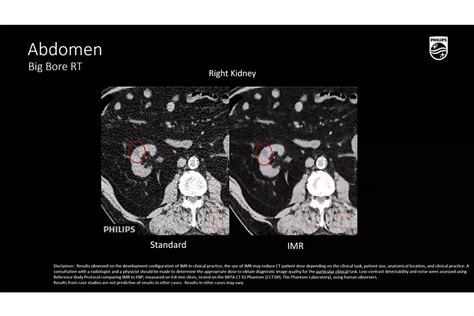 Philips - Big Bore RT Big Bore RT