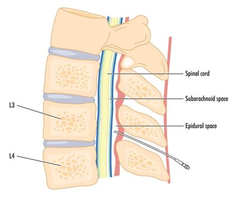 Spinal Block Vs Epidural