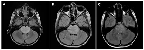 Updates in Diagnostic Techniques and Experimental Therapies for Diffuse Intrinsic Pontine Glioma
