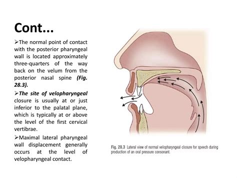 Velopharyngeal dysfunction (VPD) | PPTX