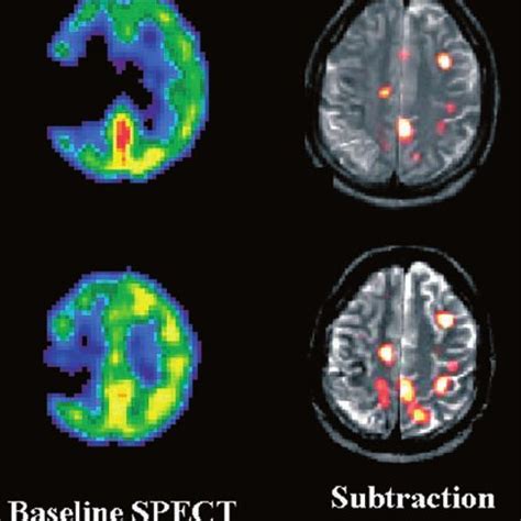 Image result for Contralateral Hemisphere