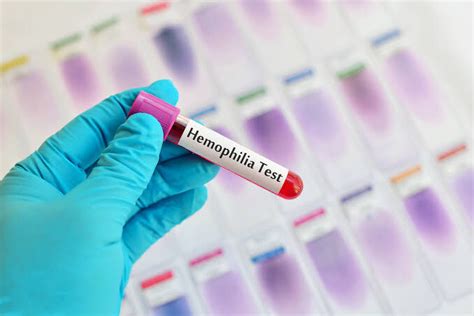 World Hemophilia Day: How genetic testing, early screening can save women?