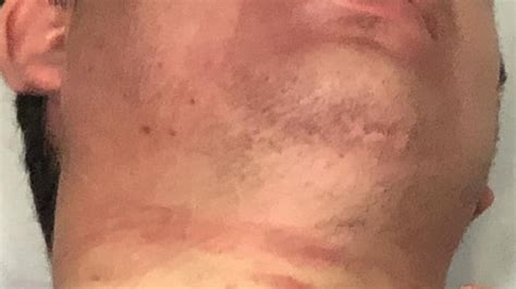 Image result for Famous Cases of Strangulation