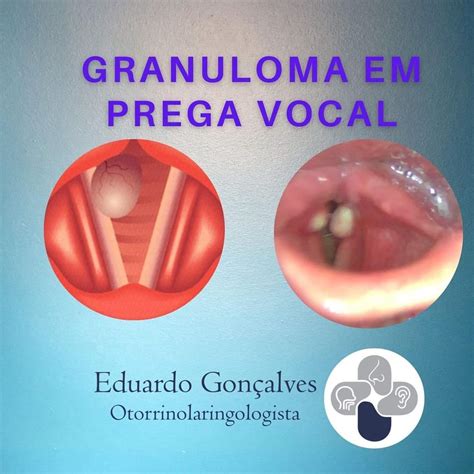 Saiba como identificar doenças como o Granuloma em Prega Vocal ...