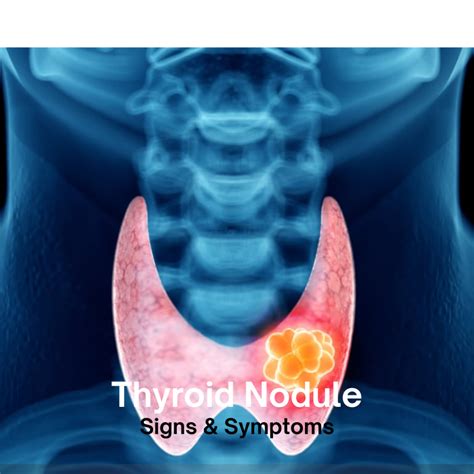 Understanding Thyroid Nodules: Causes, Symptoms, Diagnosis, and Treatment