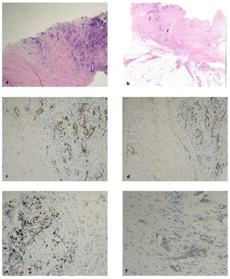 Breast Cancer Molecular Subtyping in Practice: A Real-World Study of ...