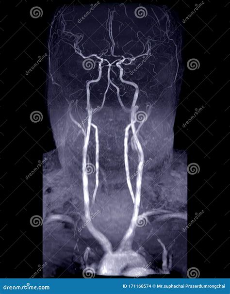 MRA Brain and Neck or Magnetic Resonance Angiography MRA of Cerebral Artery and Common Carotid ...