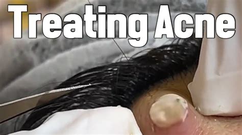 Image result for Exploding Spots