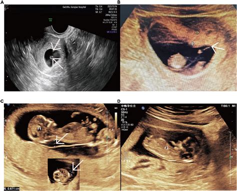 Frontiers | Determining the cause of intrauterine fetal death in monochorionic twins: A case report