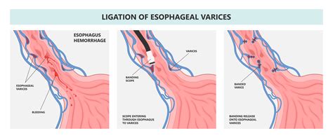 Esophageal Varices Banding