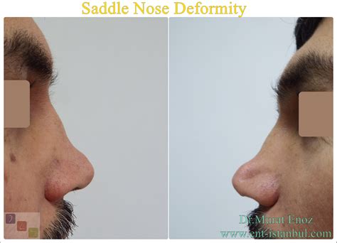Saddle Nose Deformity: Understanding Causes, Diagnosis, and Treatment Solutions