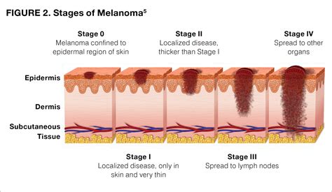 Melanoma pictures by stages, stage 0-1-2-3-4 melanoma pictures, melanoma in situ picture ...
