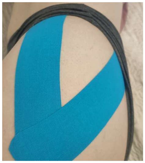 Kinesiology Tape For Gluteus Medius at Kathy Lighty blog