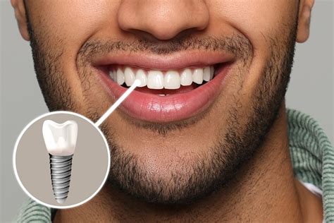 Tooth Implants Procedure 的图像结果