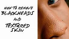 How To Do A Small Bump In Your Hair by How To Get Rid Of Blackheads Tiny Bumps On Your Nose And How To Do A Small Bump In Your Hair