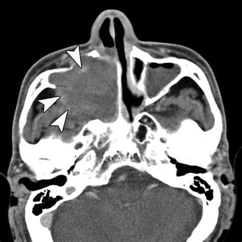 Organized Hematoma of the Maxillary Sinus: CT Findings | AJR