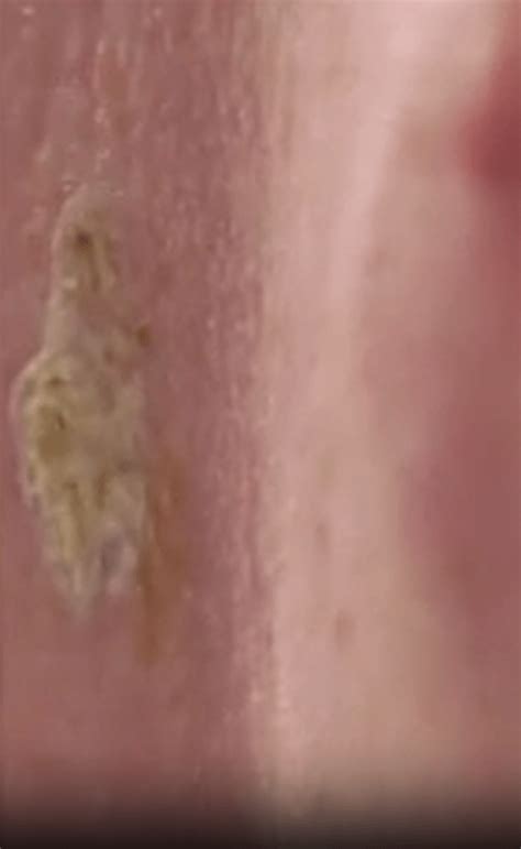 Image result for Explosive Back Cysts