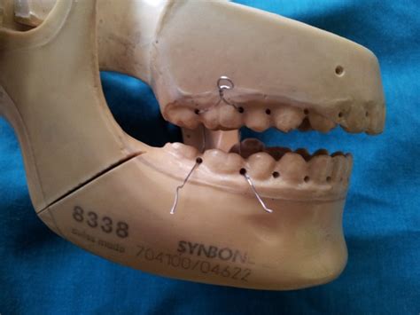 Image result for Transnasal Loop Fixation