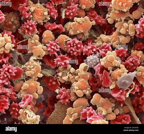 Cells from a urine infection. Coloured scanning electron micrograph ...