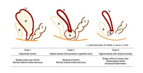 Hydrometrocolpos in Infants: Etiologies and Clinical Presentations