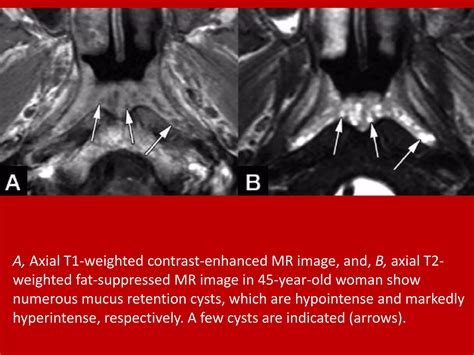 Dr ahmed esawy imaging of adeniod enlargment | PDF