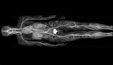 Whole Body 3T MRI - Brisbane Radiology - Book your Whole Body 3T MRI Now