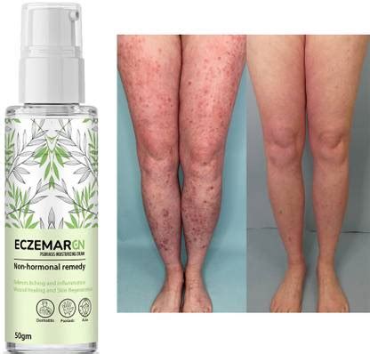 CHITAAKSH Eczemaron Anti Fungal Cream For Men & Women (50 g) - Price in ...