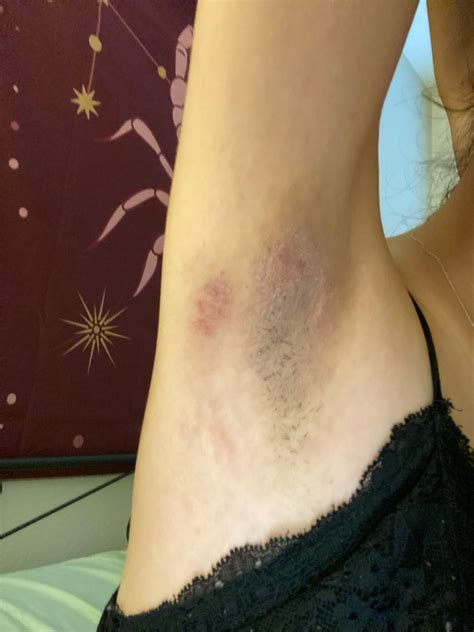 eczema in armpit? started a few weeks ago and is only in one, super itchy skin that feels kind ...