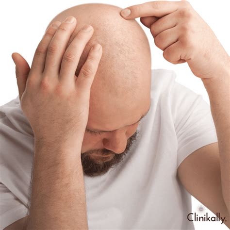 Alopecia Areata: Doctor's Guide to Treat Hair Fall