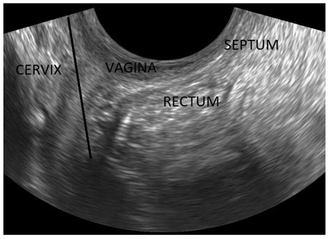Normal Uterus Ultrasound