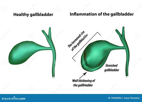What Is The Normal Size Of The Gallbladder Wall at Crystal Frasher blog