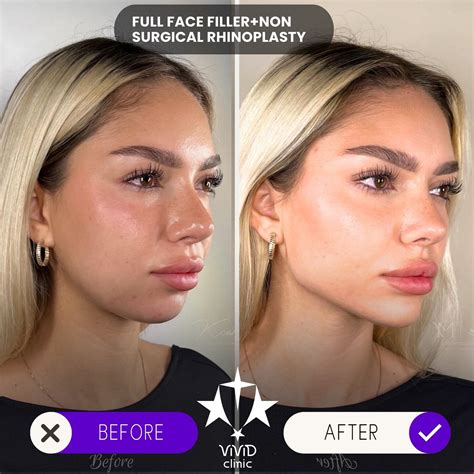 💉 Sculpt and define your face with Jawline Filler at Vivid Clinic! Check out this stunning ...