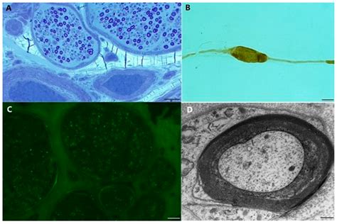 Mechanisms of Nerve Damage in Neuropathies Associated with ...