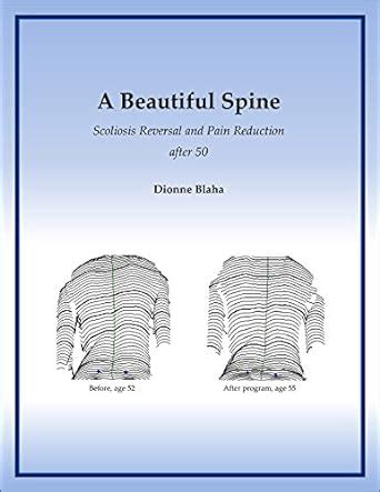 A Beautiful Spine: Scoliosis Reversal and Pain Reduction after 50 eBook ...