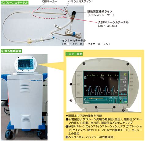 大動脈バルーンパンピング： IABP | ドレーン・カテーテル・チューブ管理 | 看護roo![カンゴルー]