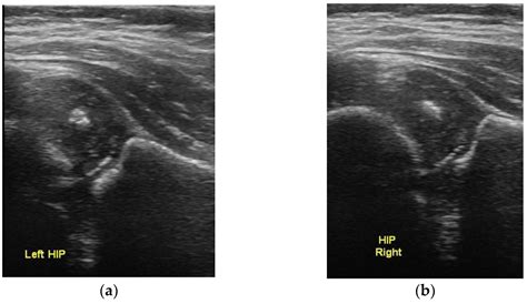 Concentric Circles: A New Ultrasonographic Sign for the Diagnosis of ...