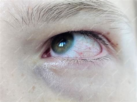 Premium Photo | Closeup of human eye with redness and blood vessels