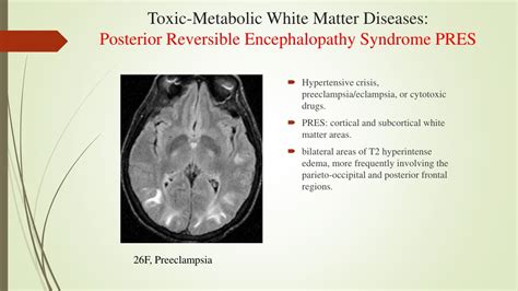 PPT - White Matter Diseases: Causes & Classification PowerPoint Presentation - ID:8763007