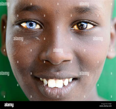 A Kenyan boy that has two different color eyes. this symptom is known as Heterochromia of the ...