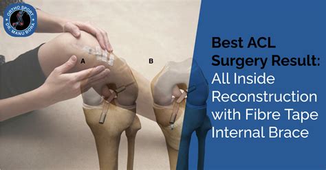 ACL repair comparison