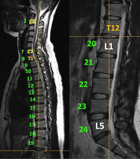 A Review of Symptomatic Lumbosacral Transitional Vertebrae: Bertolotti ...