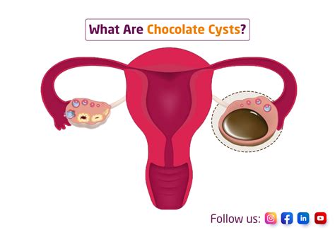 Chocolate Cyst In Endometriosis at Latisha Compton blog